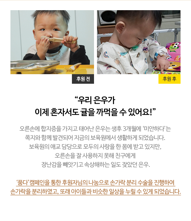 
                        “우리 은우가 
                            이제 혼자서도 귤을 까먹을 수 있어요!”
                            오른손에 합지증을 가지고 태어난 은우는 생후 3개월에 ‘미안하다’는 
                            쪽지와 함께 발견되어 지금의 보육원에서 생활하게 되었습니다. 
                            보육원의 애교 담당으로 모두의 사랑을 한 몸에 받고 있지만, 
                            오른손을 잘 사용하지 못해 친구에게 
                            장난감을 빼앗기고 속상해하는 일도 잦았던 은우.

                            ‘품다’캠페인을 통한 후원자님의 나눔으로 손가락 분리 수술을 진행하여 
                            손가락을 분리하였고, 또래 아이들과 비슷한 일상을 누릴 수 있게 되었습니다.

                        